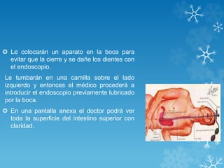  Le colocarán un aparato en la boca para
evitar que la cierre y se dañe los dientes con
el endoscopio.
Le tumbarán en una camilla sobre el lado
izquierdo y entonces el médico procederá a
introducir el endoscopio previamente lubricado
por la boca.
 En una pantalla anexa el doctor podrá ver
toda la superficie del intestino superior con
claridad.
 