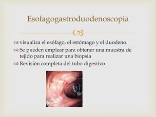 
 visualiza el esófago, el estómago y el duodeno.
 Se pueden emplear para obtener una muestra de
tejido para realizar una biopsia
 Revisión completa del tubo digestivo
Esofagogastroduodenoscopia
 