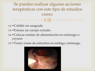 
 •Cohibir un sangrado
 •Extraer un cuerpo extraño
 •Colocar sondas de alimentación en estómago o
yeyuno
 •Tratar zonas de estrechez en esófago, estómago
Se pueden realizar algunas acciones
terapéuticas con este tipo de estudios
como:
 