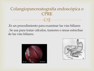 
.Es un procedimiento para examinar las vías biliares
. Se usa para tratar cálculos, tumores o áreas estrechas
de las vías biliares.
Colangiopancreatografía endoscópica o
CPRE
 