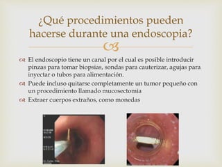 
 El endoscopio tiene un canal por el cual es posible introducir
pinzas para tomar biopsias, sondas para cauterizar, agujas para
inyectar o tubos para alimentación.
 Puede incluso quitarse completamente un tumor pequeño con
un procedimiento llamado mucosectomìa
 Extraer cuerpos extraños, como monedas
¿Qué procedimientos pueden
hacerse durante una endoscopia?
 