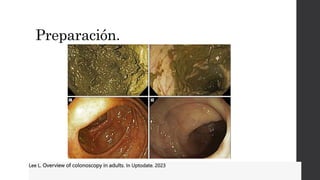 Preparación.
Lee L. Overview of colonoscopy in adults. In Uptodate. 2023
 
