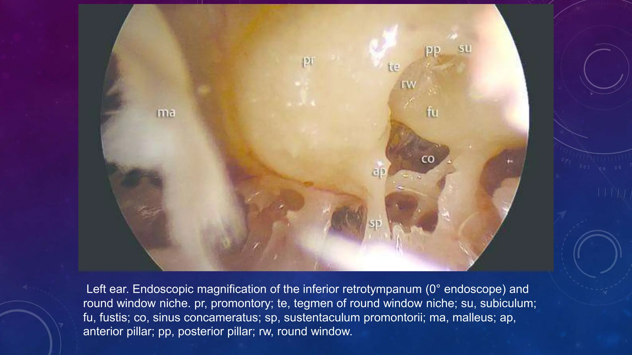 Endoscopic Anatomy Of Middle Ear jshpptx PPTX