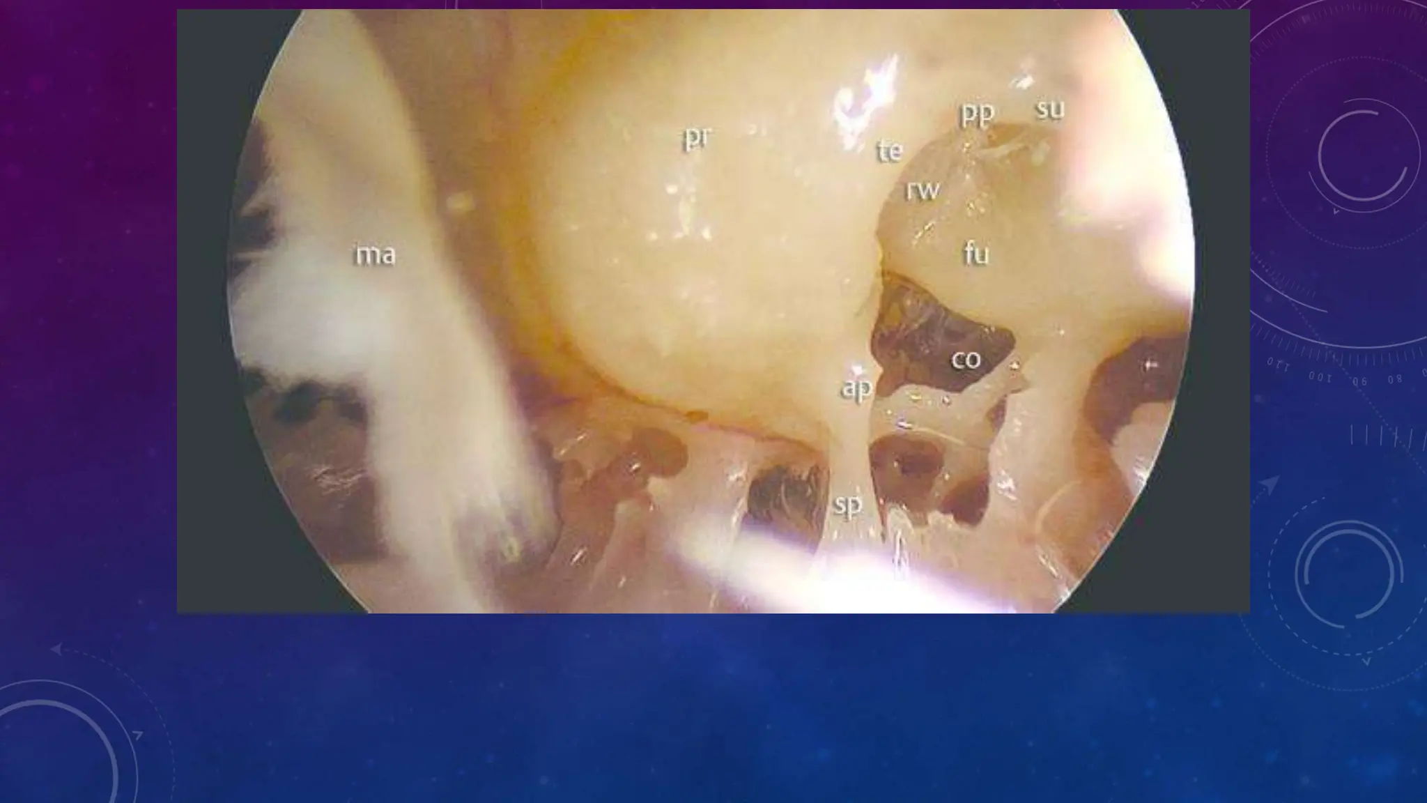 Endoscopic anatomy of middle ear.phggjjptx | PPTX