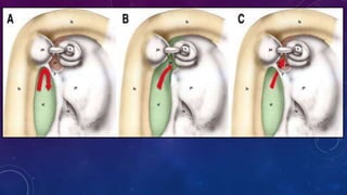 Endoscopic anatomy of middle ear.phggjjptx | PPT