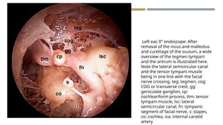 ENDOSCOPIC ANATOMY OF MIDDLE EAR CLEFT AND MUCOSAL FOLDS.pptx