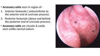 Accessory Ostium endoscopic anatomy of nasal cavity & paranasal sinuses.pptx
