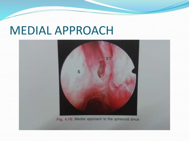 Endoscopic anatomy of nose ,paranasal sinus and anterior skull base ...