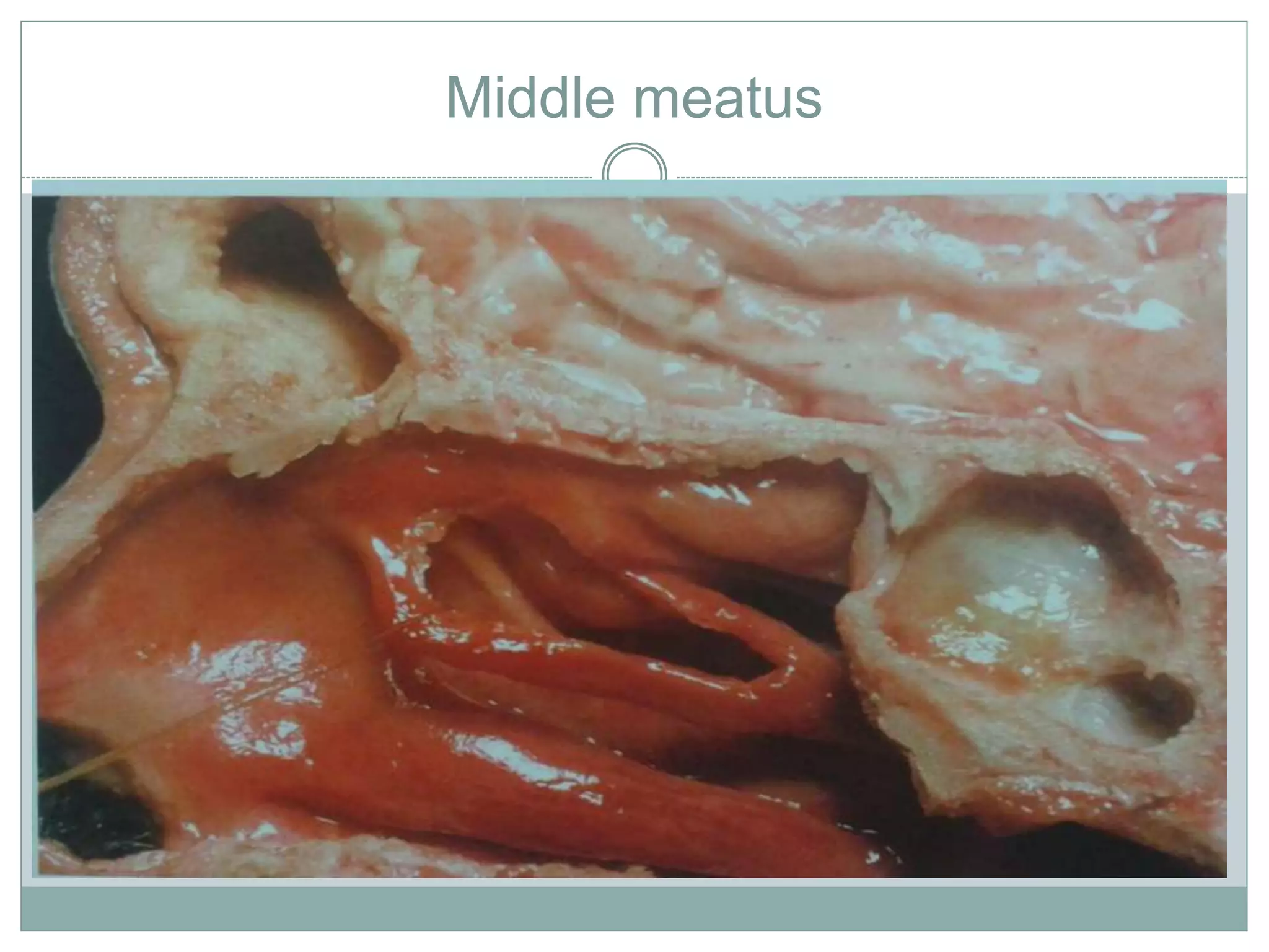 Endoscopic anatomy of nose and PNS | PPTX