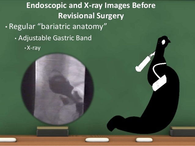 Endoscopy Before Weight Loss Surgery