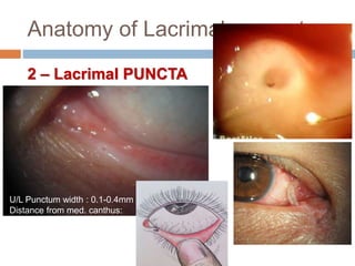 Anatomy of Lacrimal apparatus
2 – Lacrimal PUNCTA
U/L Punctum width : 0.1-0.4mm
Distance from med. canthus:
0.6mm
 