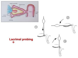 Lacrimal probing

 
