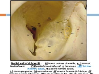 Medial wall of right orbit… FP frontal process of maxilla, ALC anterior
lacrimal crest, PLC posterior lacrimal crest, H hammulus, LMS lacrimo-
maxillary suture, FES fronto-ethmoid suture,
LP lamina papyracea, LB lacrimal bone, AF anterior foramen (AE Artery), PF
LF
 