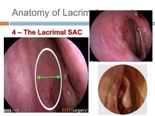 Anatomy of Lacrimal apparatus
4 – The Lacrimal SAC
 