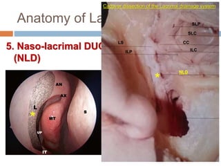 Anatomy of Lacrimal apparatus
5. Naso-lacrimal DUCT
(NLD)
ILP
SLC
SLP
ILC
CC
NLD
Cadaver dissection of the Lacrimal drainage system
LS
*
*
 