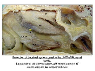 Projection of Lacrimal system canal in the LNW of Rt. nasal
cavity.
L projection of the lacrimal system, MT middle turbinate, IT
inferior turbinate, ST superior turbinate
*
 