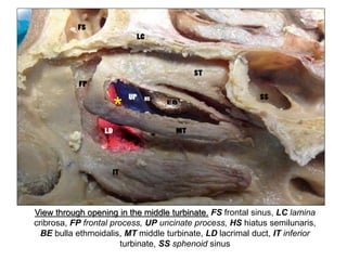 View through opening in the middle turbinate. FS frontal sinus, LC lamina
cribrosa, FP frontal process, UP uncinate process, HS hiatus semilunaris,
BE bulla ethmoidalis, MT middle turbinate, LD lacrimal duct, IT inferior
turbinate, SS sphenoid sinus
*
 