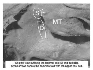 Sagittal view outlining the lacrimal sac (S) and duct (D).
Small arrows denote the common wall with the agger nasi cell.
 