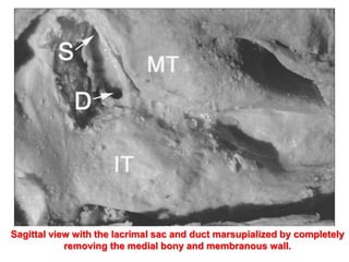 Sagittal view with the lacrimal sac and duct marsupialized by completely
removing the medial bony and membranous wall.
 