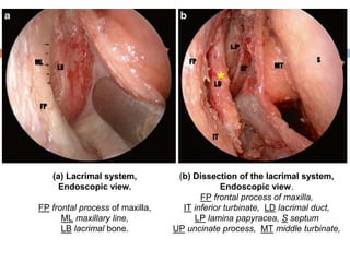 (a) Lacrimal system,
Endoscopic view.
FP frontal process of maxilla,
ML maxillary line,
LB lacrimal bone.
*
(b) Dissection of the lacrimal system,
Endoscopic view.
FP frontal process of maxilla,
IT inferior turbinate, LD lacrimal duct,
LP lamina papyracea, S septum
UP uncinate process, MT middle turbinate,
 