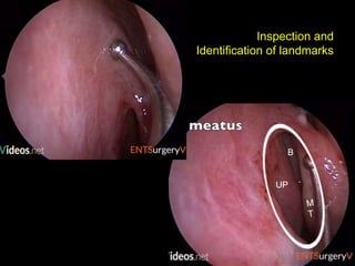 Inspection and
Identification of landmarks
UP
B
 