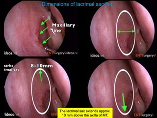 Dimensions of lacrimal sac/flap
The lacrimal sac extends approx.
10 mm above the axilla of MT.
 