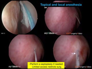Topical and local anesthesia
Perform a septoplasty if needed:
Limited access restricts surg.
 