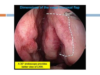 Dimensions of the nasal mucosal flap
A 30 endoscope provides
better view of LNW.
 