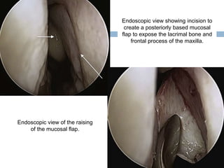 Endoscopic view showing incision to
create a posteriorly based mucosal
flap to expose the lacrimal bone and
frontal process of the maxilla.
Endoscopic view of the raising
of the mucosal flap.
 