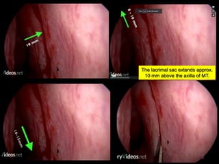 The lacrimal sac extends approx.
10 mm above the axilla of MT.
 