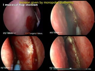 Incision given by monopolar diathermy
 