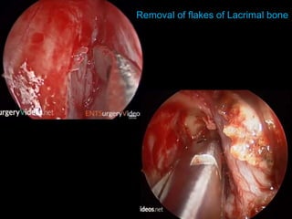 Removal of flakes of Lacrimal bone
 
