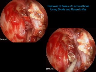 Removal of flakes of Lacrimal bone
Using Sickle and Rosen knifes
 