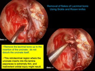 Removal of flakes of Lacrimal bone
Using Sickle and Rosen knifes
Remove the lacrimal bone up to the
insertion of the uncinate : do not
disturb the uncinate itself.
This retrolacrimal region where the
uncinate inserts into the lamina
papyracea is extremely thin, and
inadvertent orbital injury might result.
 