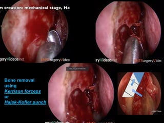 Bone removal
using
Kerrison forceps
or
Hajek-Kofler punch
 