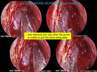 Use of DIAMOND BURR for bone removal
 Use diamond burr only when the punch
is unable to grip the bone adequately.
 