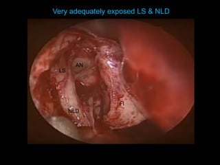 LS
NLD
Fl
AN
Very adequately exposed LS & NLD
 