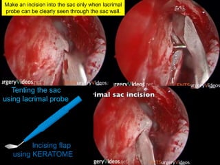 Incising flap
using KERATOME
Tenting the sac
using lacrimal probe
Make an incision into the sac only when lacrimal
probe can be clearly seen through the sac wall.
 