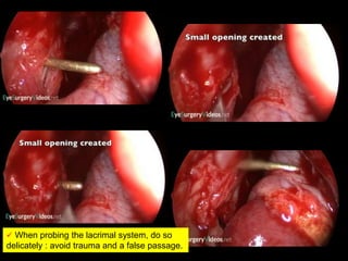  When probing the lacrimal system, do so
delicately : avoid trauma and a false passage.
 