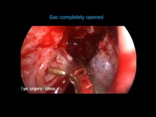 Sac completely opened
 