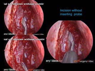 Incision without
inserting probe
 