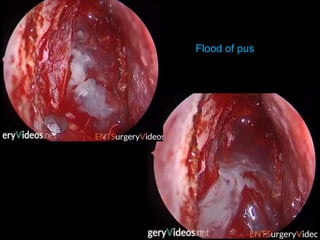 Flood of pus
 