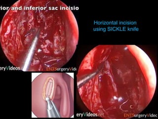 Horizontal incision
using SICKLE knife
 