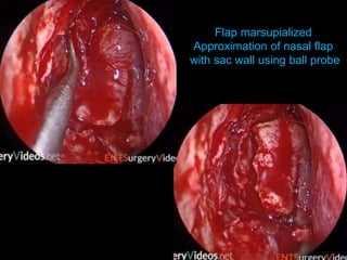 Flap marsupialized
Approximation of nasal flap
with sac wall using ball probe
 