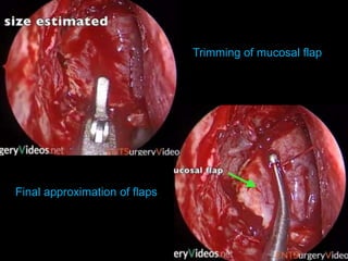 Trimming of mucosal flap
Final approximation of flaps
 