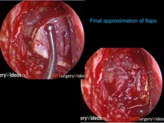 Final approximation of flaps
 