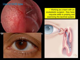 Use of DCR tube
 Working as a team with an
oculoplastic surgeon : they have
requisite skills in probing and
examining the lacrimal system.
 