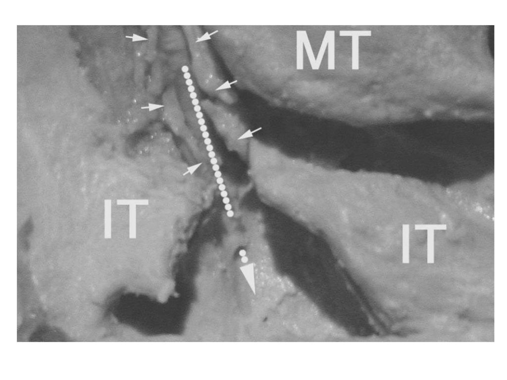 Endoscopic (DCR) Dacryocystorhinostomy
