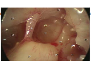 Docking Ear Process Endoscopic ear surgery | PPTX