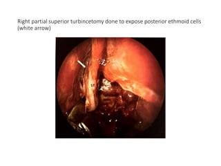 Right partial superior turbincetomy done to expose posterior ethmoid cells
(white arrow)
 
